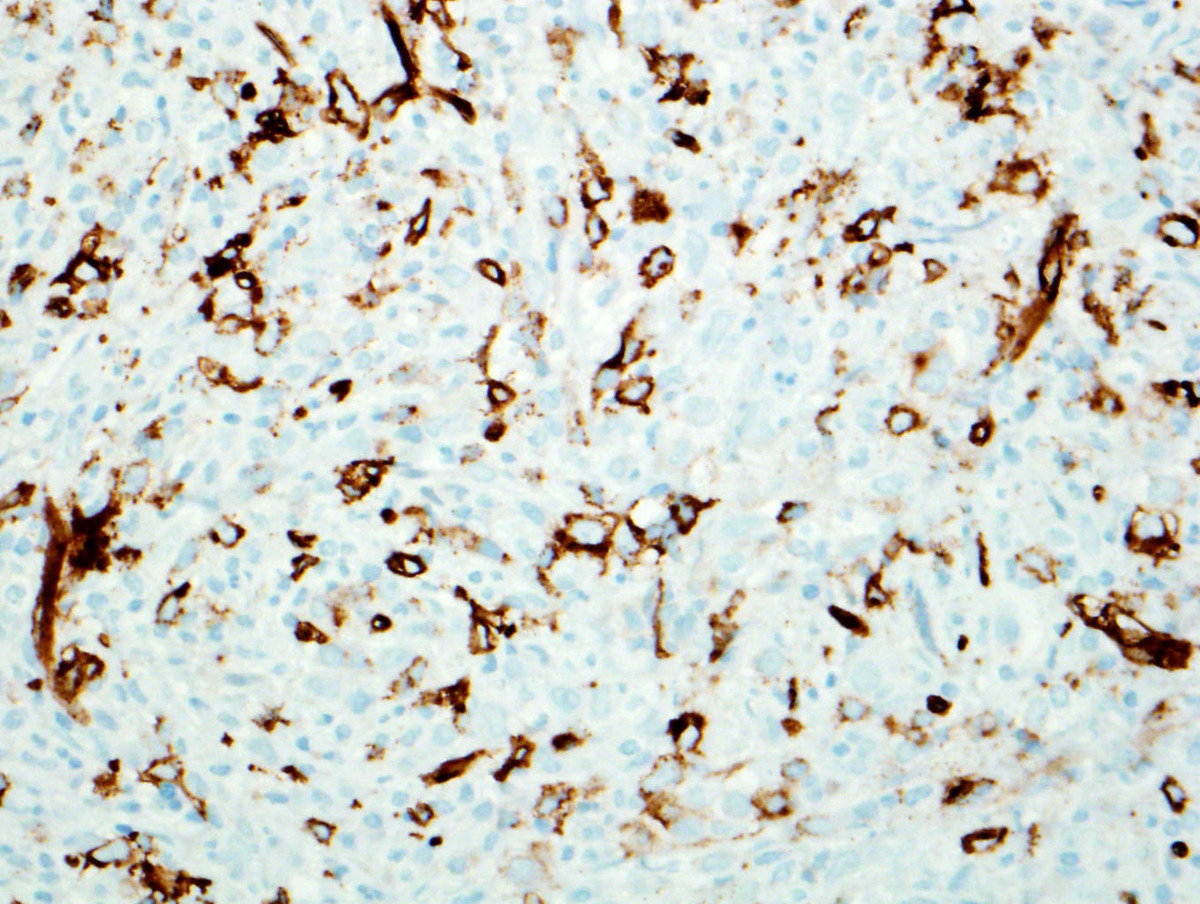 Fig. 4 Immunohistochemical staining for CD34 revealed approximately 50-60% blasts in the marrow.